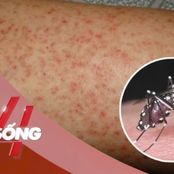 NHỊP SỐNG 24: Vì sao Chikungunya dễ nhầm với sốt xuất huyết?