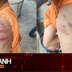 TIN NHANH: Lý do người cha đánh con 10 tuổi bầm tím khắp người