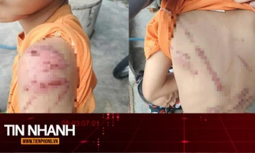 TIN NHANH: Lý do người cha đánh con 10 tuổi bầm tím khắp người