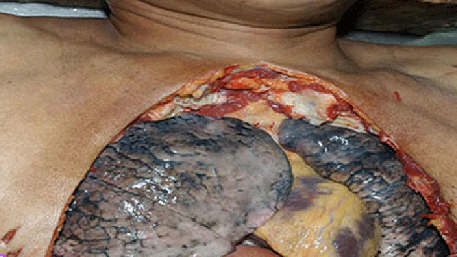 Hình ảnh phổi đen kịt vì chất độc từ thuốc lá.