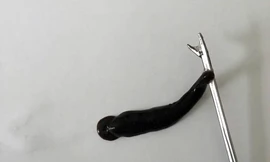 Gắp con đỉa dài 4cm sống trong mũi bé trai ở Quảng Trị