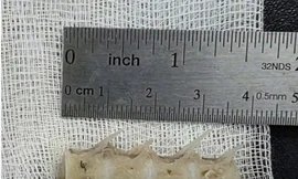 Lấy xương cá 'khủng' găm chặt vào thực quản của cụ ông 99 tuổi