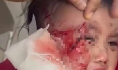 Sập trần thạch cao giờ ngủ trưa, một trẻ mầm non bị thương nặng