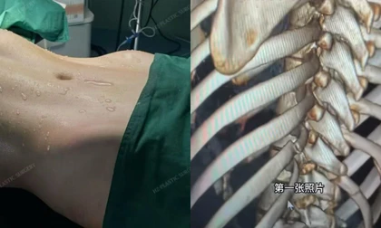 Xu hướng bẻ xương sườn để có vòng eo con kiến