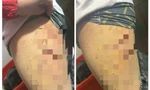 Nữ sinh lớp 7 bị bạn dùng bút bi đâm chi chít vào đùi
