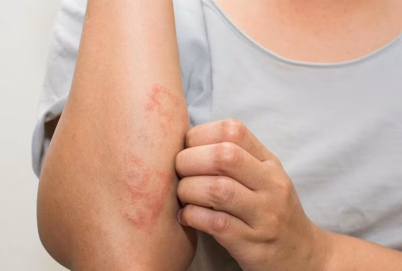 Nổi mẩn tưởng dị ứng thông thường, trẻ gặp nguy cơ tổn thương thận