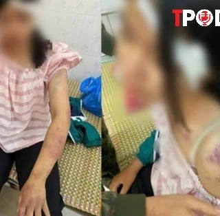 NÓNG 20/11: Bé gái bị gia đình nội tra tấn: Đây là hành vi nghiêm trọng
