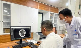 Các bác sĩ quan sát tổn thương trên não bệnh nhân do sử dụng bóng cười 