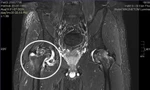 Bác sĩ ngoại quốc chẩn đoán sai, Việt kiều về nước được điều trị khỏi bệnh 