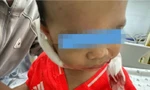 Bé trai 2 tuổi bị chó nhà nuôi cắn nhiều vết trên mặt