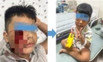 Nhiều trẻ bị thú nuôi tấn công, phải cấp cứu