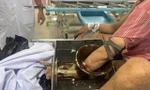 Bệnh nhân nhập viện với bàn tay kẹt trong cối máy xay thịt