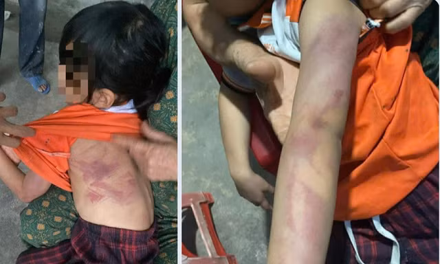 Bé gái lớp 2 bị bạn dùng thước đánh bầm tím người trong giờ ra chơi