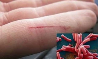 Người đàn ông tử vong do nhiễm 'vi khuẩn ăn thịt người'