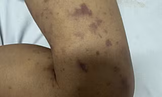 Cháu tử vong do não mô cầu, chú ruột 40 tuổi cũng nhiễm bệnh