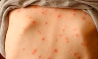 Phát hiện ổ dịch thuỷ đậu tại một điểm trường tiểu học ở Đắk Lắk