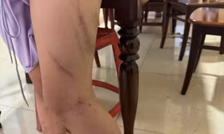 Bé gái 9 tuổi chi chít vết bầm trên cơ thể, nghi bị mẹ bạo hành