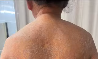 Lạm dụng thuốc bôi không rõ nguồn gốc, người phụ nữ mắc nấm da toàn thân