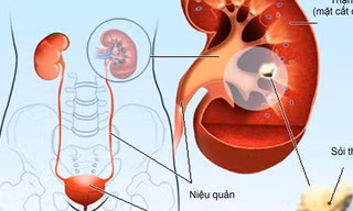 Cách phòng ngừa sỏi thận không dùng thuốc