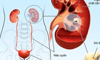 Cách phòng ngừa sỏi thận không dùng thuốc