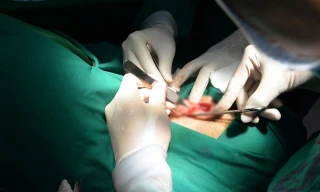 Bác sĩ gắp 5 con giòi sống ra từ ống tai bệnh nhân