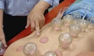 Đột quỵ nặng khi nhờ chị gái giác hơi