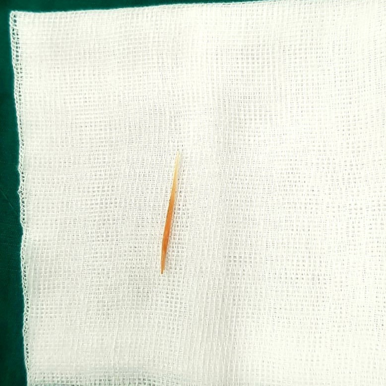 Bé gái 1 tuổi suýt chết vì nuốt phải tăm xỉa răng