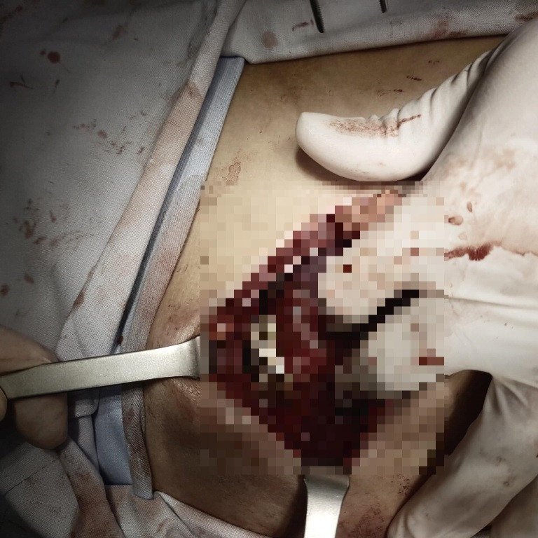 Bé trai 13 tuổi bị thanh sắt đâm thấu ngực khi đi cắt lúa 