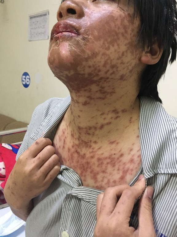 Biến dạng khuôn mặt vì tự ý dùng thuốc đau đầu