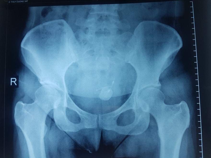 Gắp thành công vòng tránh thai ‘đi lạc’ trong bàng quang nữ bệnh nhân