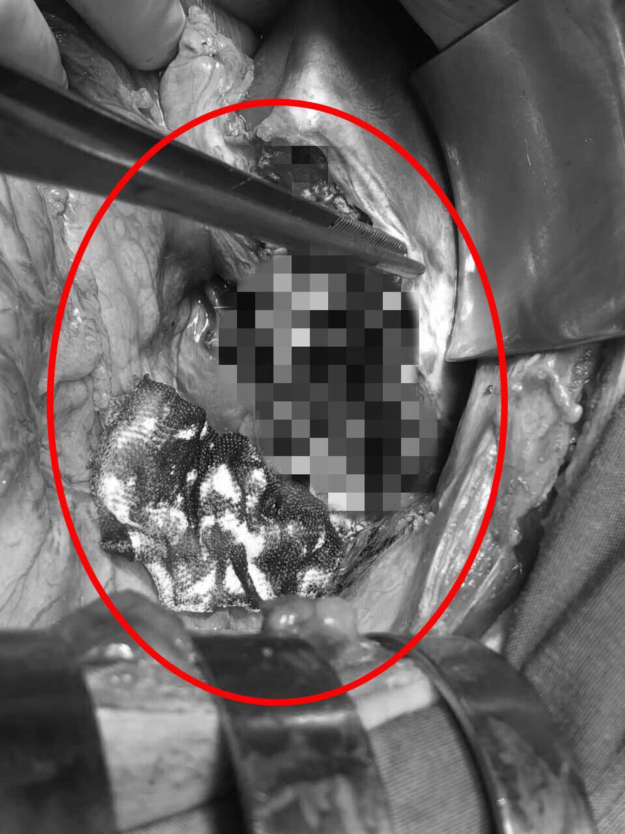 Cứu sống nam thanh niên đứt lìa gan vì tai nạn giao thông