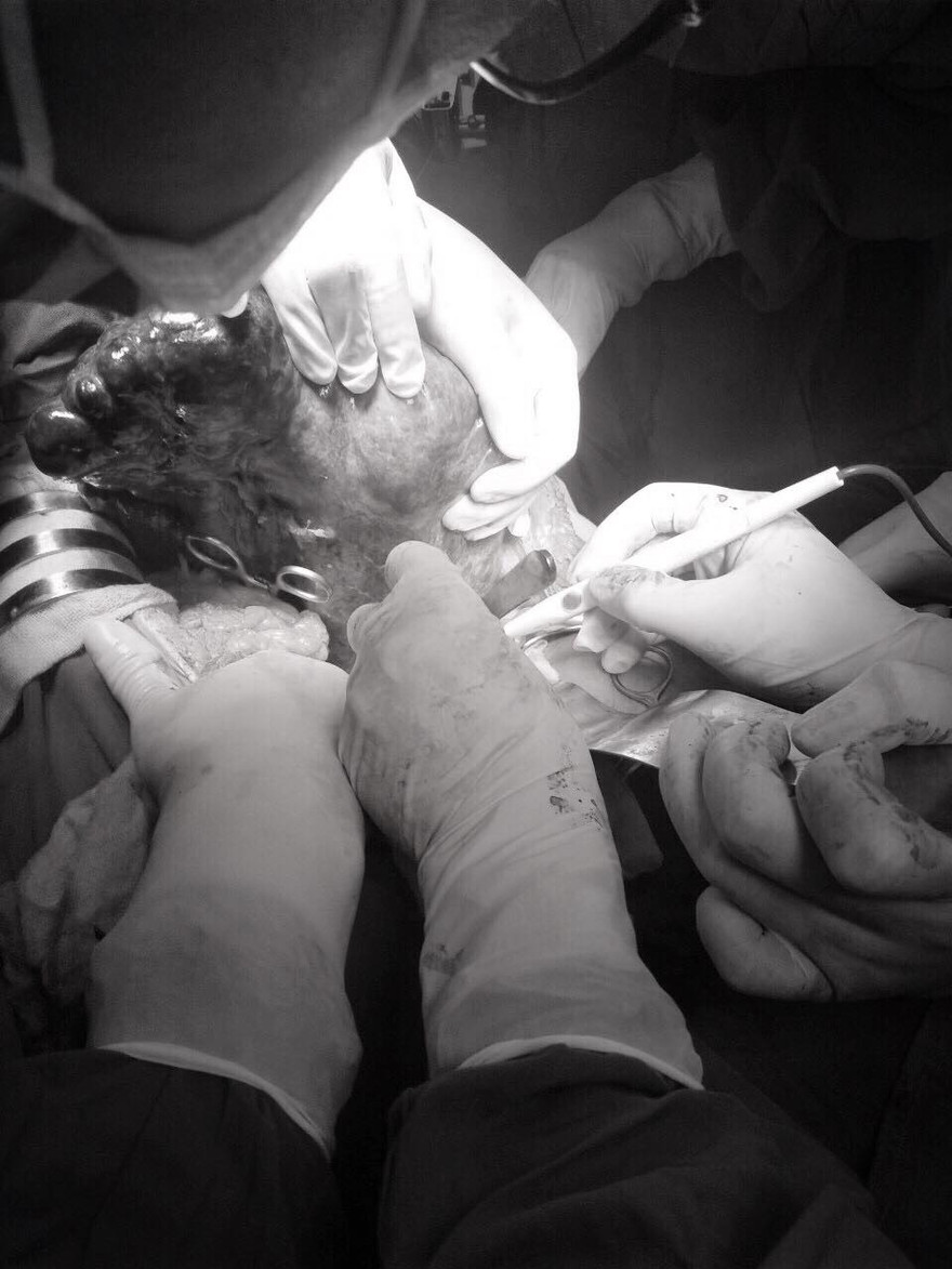 Lấy thành công khối đa nang lách dài nửa mét trong bụng người phụ nữ