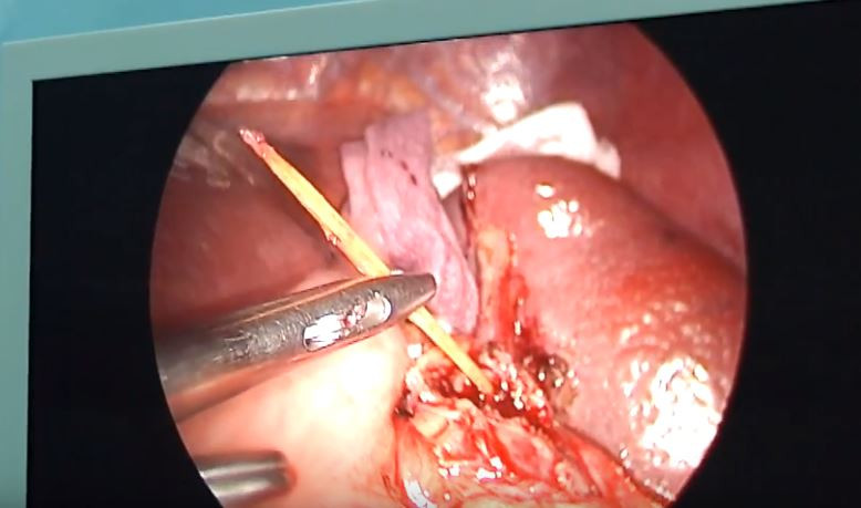 Người đàn ông bị thủng lá lách vì ngậm tăm đi ngủ