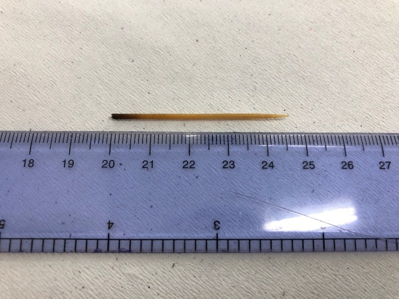 Uống nước khi đang xỉa răng, nam thanh niên bị tăm đâm xuyên dạ dày