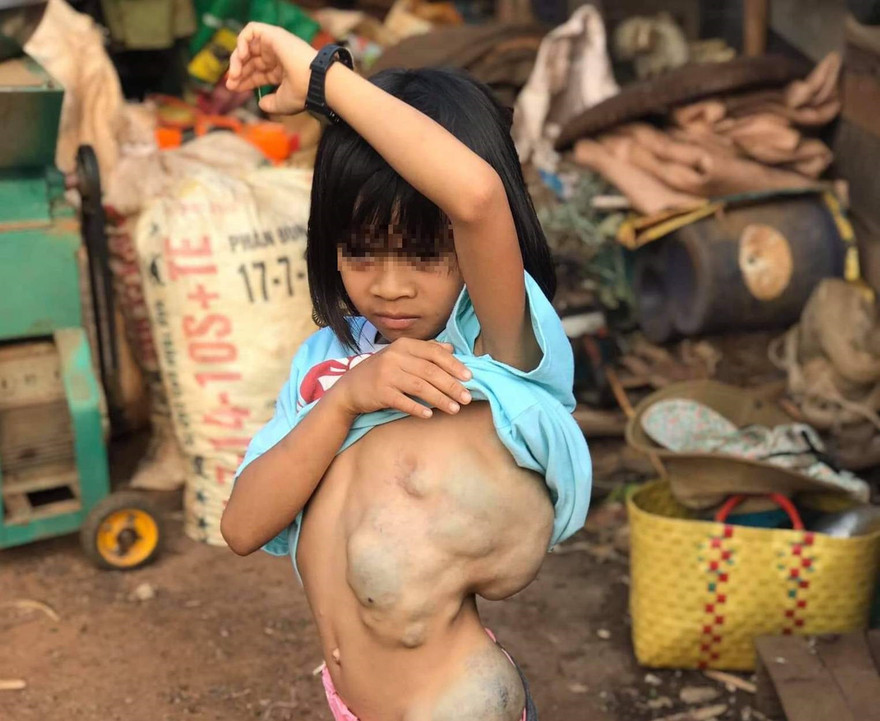 Phẫu thuật thành công cho bé gái 8 năm cõng khối bướu 4 kg trên lưng