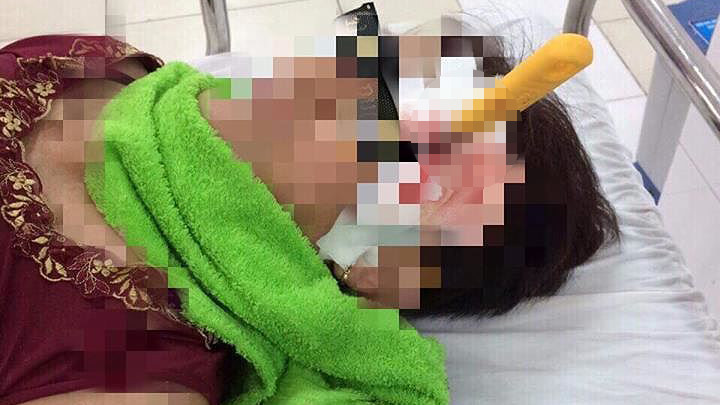 Người phụ nữ nhập viện với con dao đâm thấu não