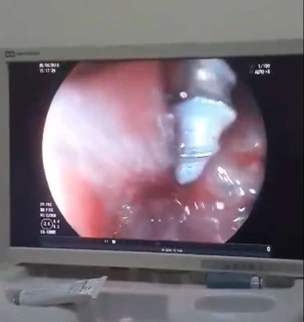 Gắp thành công đinh xoắn ốc ra khỏi dạ dày bé gái 2 tuổi