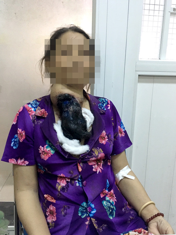 Đắp thuốc ở thầy lang, người phụ nữ vô tình 'nuôi' bướu khổng lồ