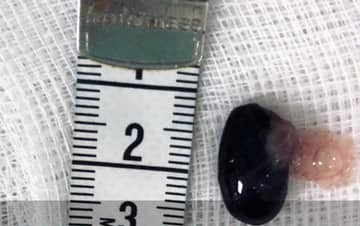 Cứu sống bé trai ngưng tim vì hóc hạt mãng cầu