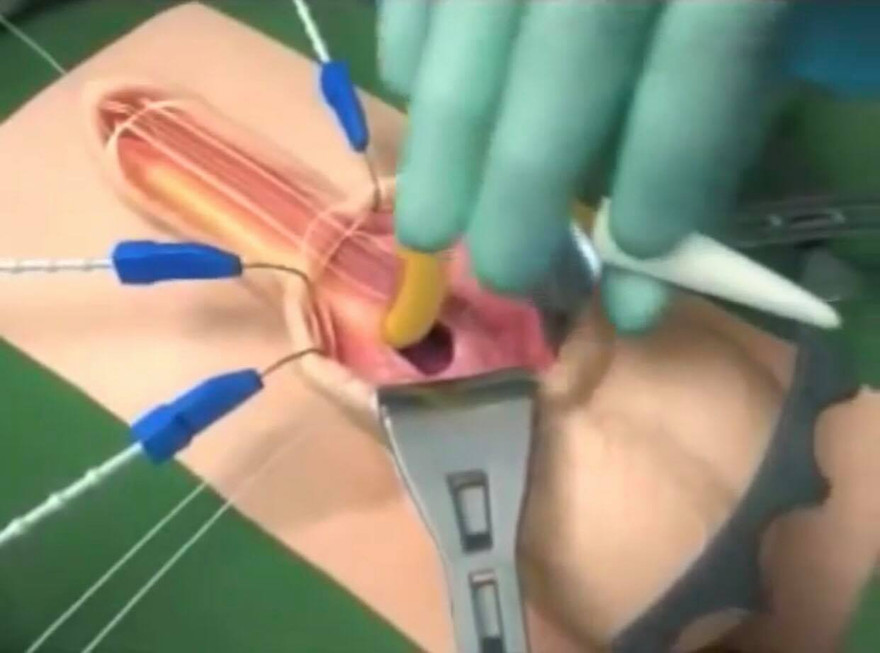 Khi 'cậu nhỏ' được điều khiển theo ý muốn nhờ... công tắc