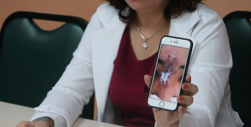 Tiêm filler tại cơ sở chui, nữ sinh viên bị hoại tử mũi