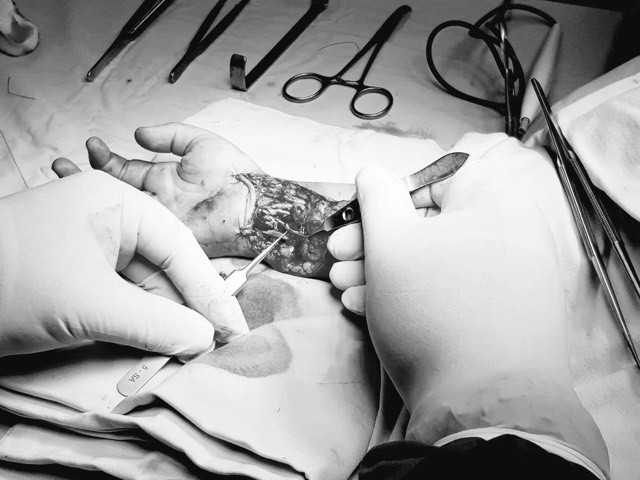 Đang tắm gặp tai nạn bất ngờ, bé trai 6 tuổi đứt gần lìa bàn tay