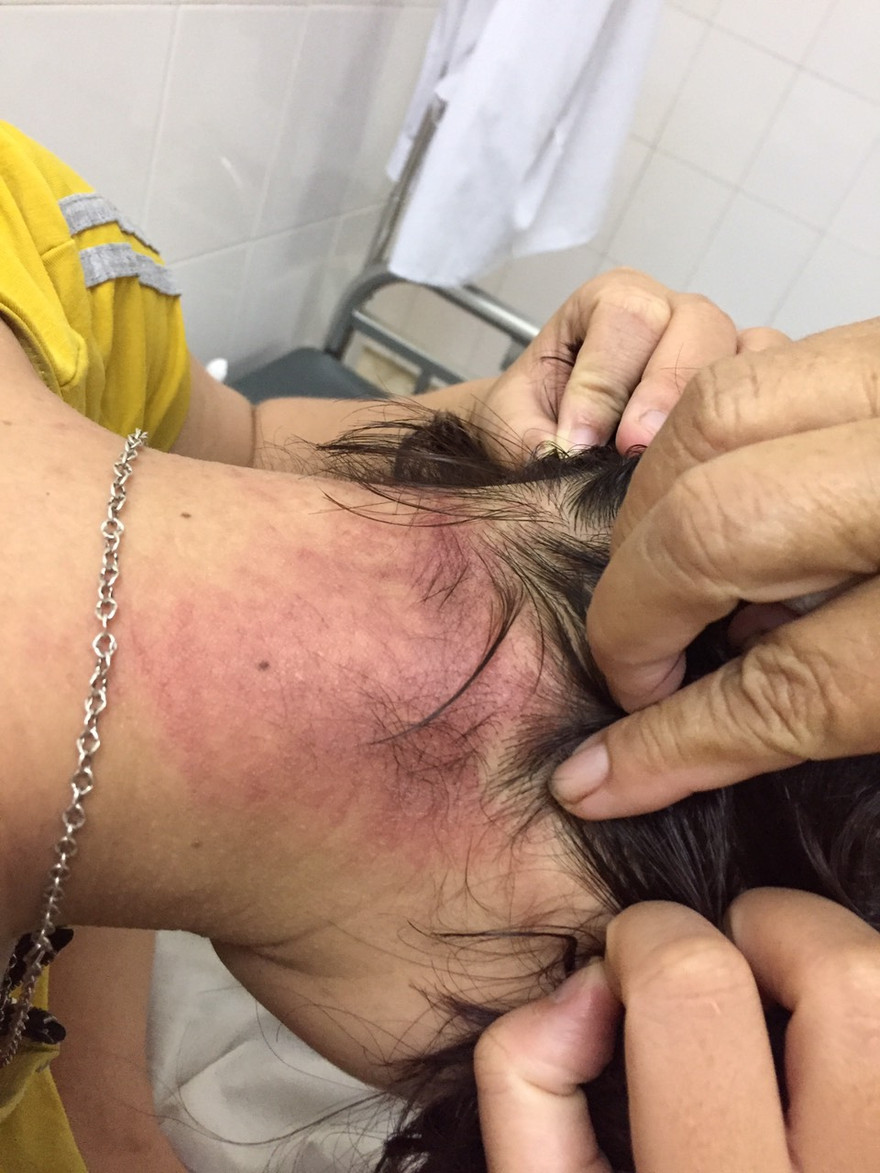 Nhiều bệnh nhân thành nạn nhân của kiến ba khoang... khi nằm viện