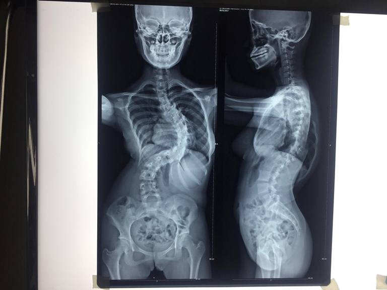 Sau phẫu thuật vẹo cột sống, thiếu nữ tăng 7 cm chiều cao