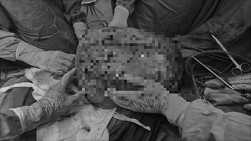 Hình ảnh khối u nặng 30 kg trong buồng trứng bệnh nhân