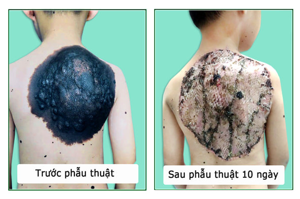 Phẫu thuật thành công “mai rùa” trên lưng bé trai 7 tuổi