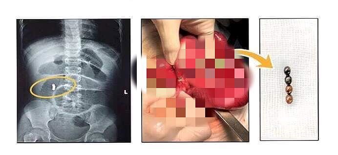 Hình ảnh 4 viên bi nam châm được gắp ra từ ruột bé gái