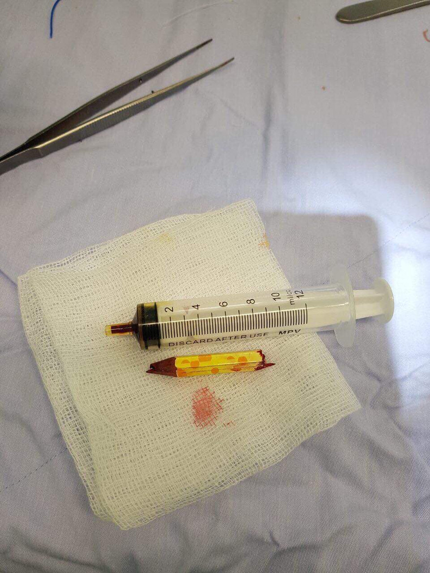 Bé gái thoát chết thần kì khi bút chì cắm vào mắt