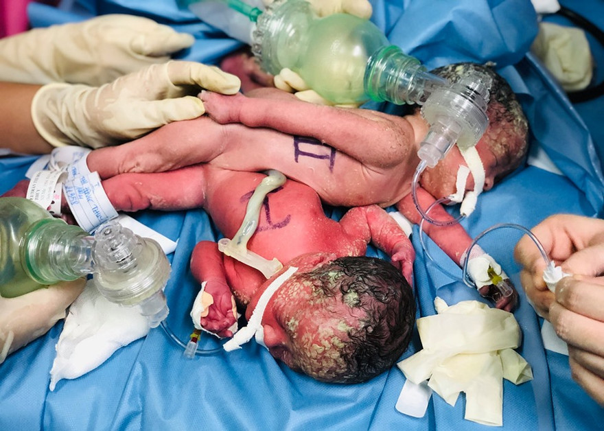 Mổ sinh thành công cho 2 bé gái song sinh dính liền, chỉ có một hậu môn