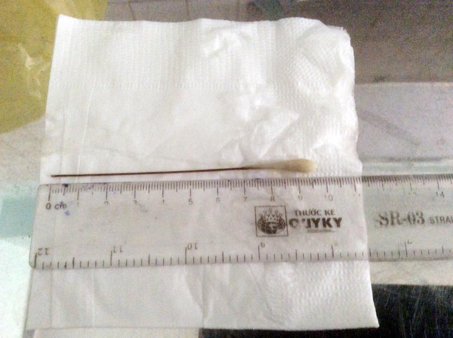 Gắp thành công tăm tre dài gần 10 cm ra khỏi phổi cụ ông